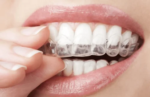 Invisalign in Goes – Tandarts DeoSmile Tandarts DeoSmile, Tandarts Goes, Tandarts Invisalign