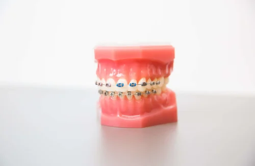 Slotjesbeugel – Tandarts DeoSmile Slotjesbeugel - Tandarts DeoSmile