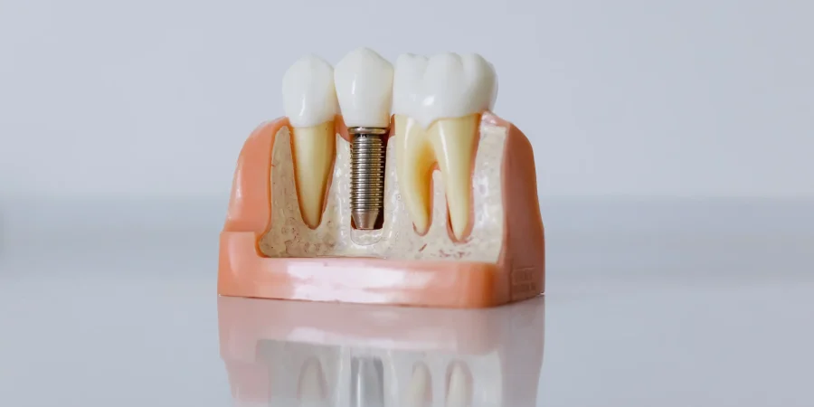 Tand Implantaten Goes – Tandarts Deosmile Tand Implantaten Goes, Tandarts DeoSmile, Kunsttand Goes